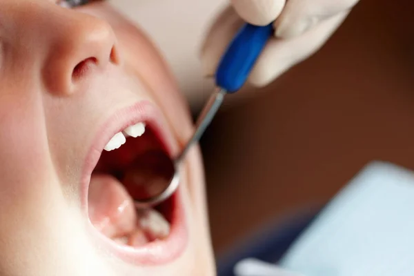 幼儿接受了牙科治疗 在牙科诊所对张嘴的幼儿进行检查 — 图库照片