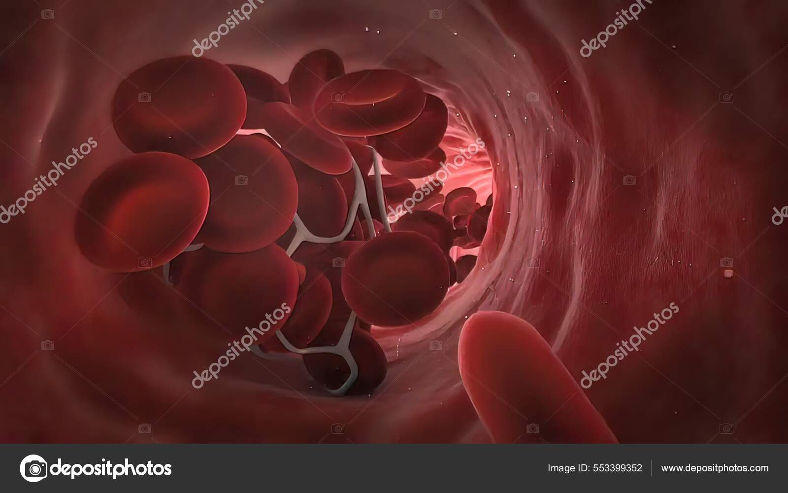Vascular Occlusion Blockage Blood Vessel Usually Clot Occurs Major Vein
