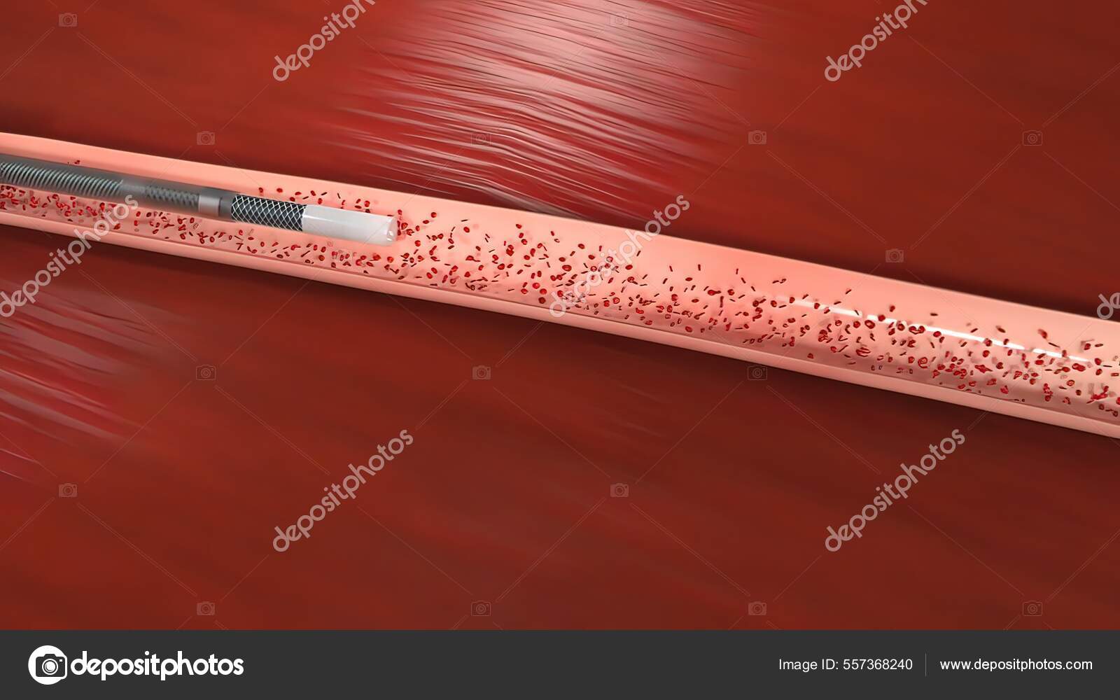 Vascular Occlusion Blockage Blood Vessel Usually Clot Illustration