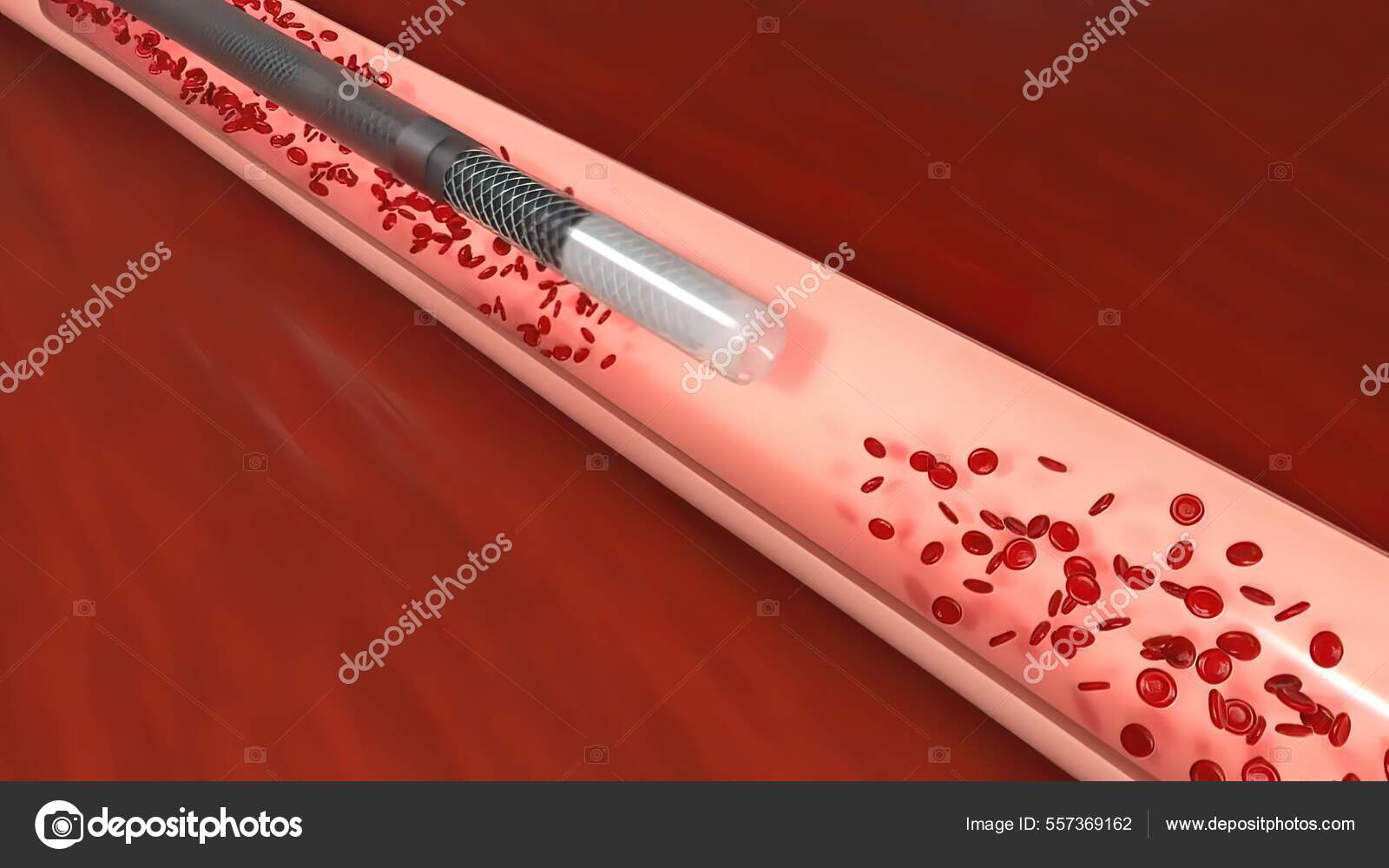 Vascular Occlusion Blockage Blood Vessel Usually Clot Illustration