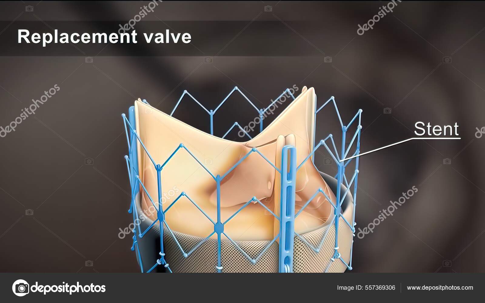 Cardiac Catheterization Procedure Used Diagnose Treat Certain
