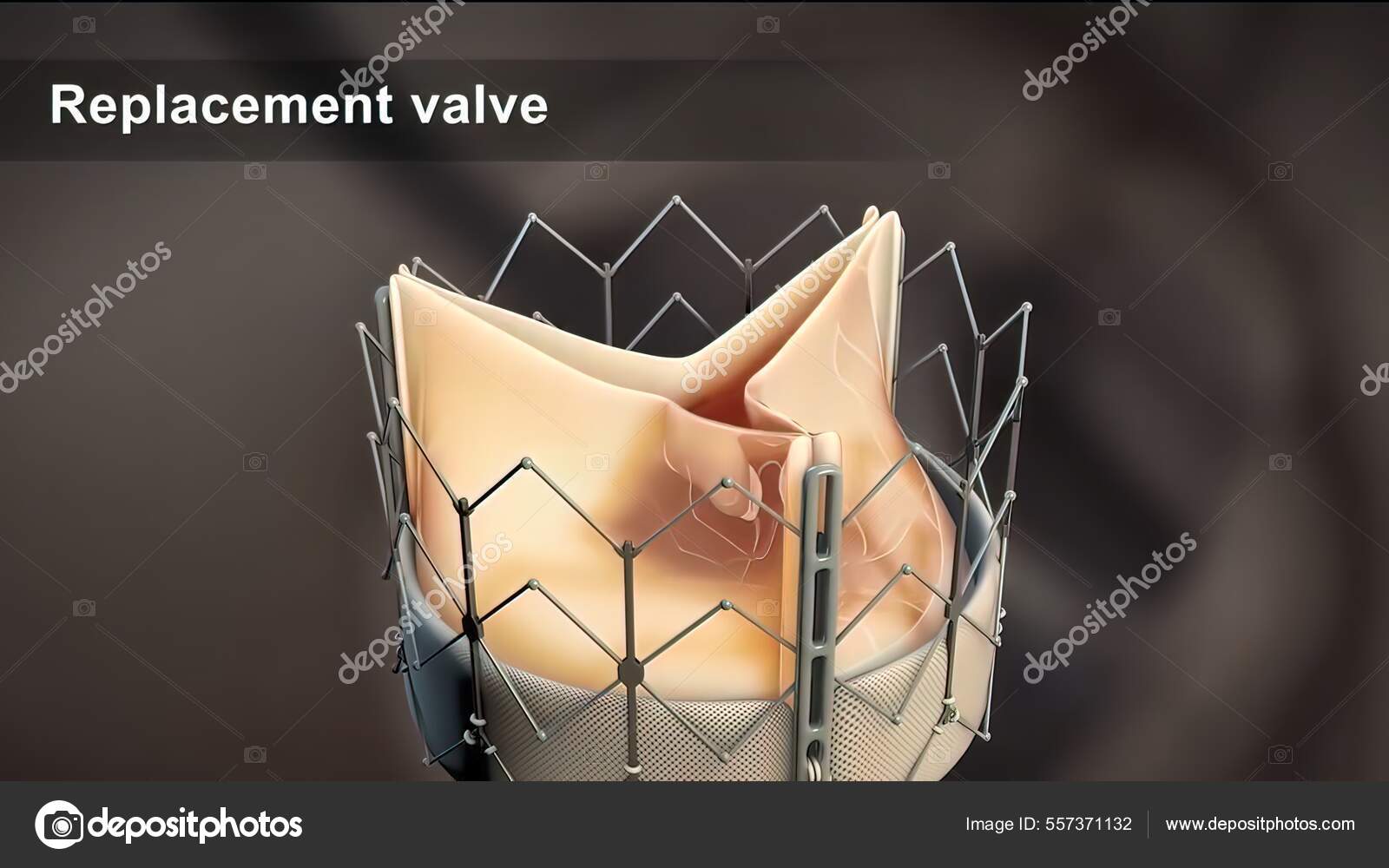 Cardiac Catheterization Procedure Used Diagnose Treat Certain