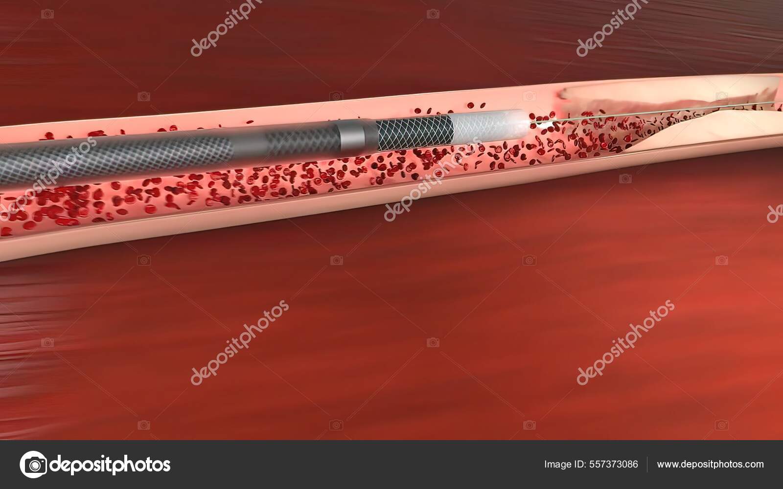 Vascular Occlusion Blockage Blood Vessel Usually Clot Illustration