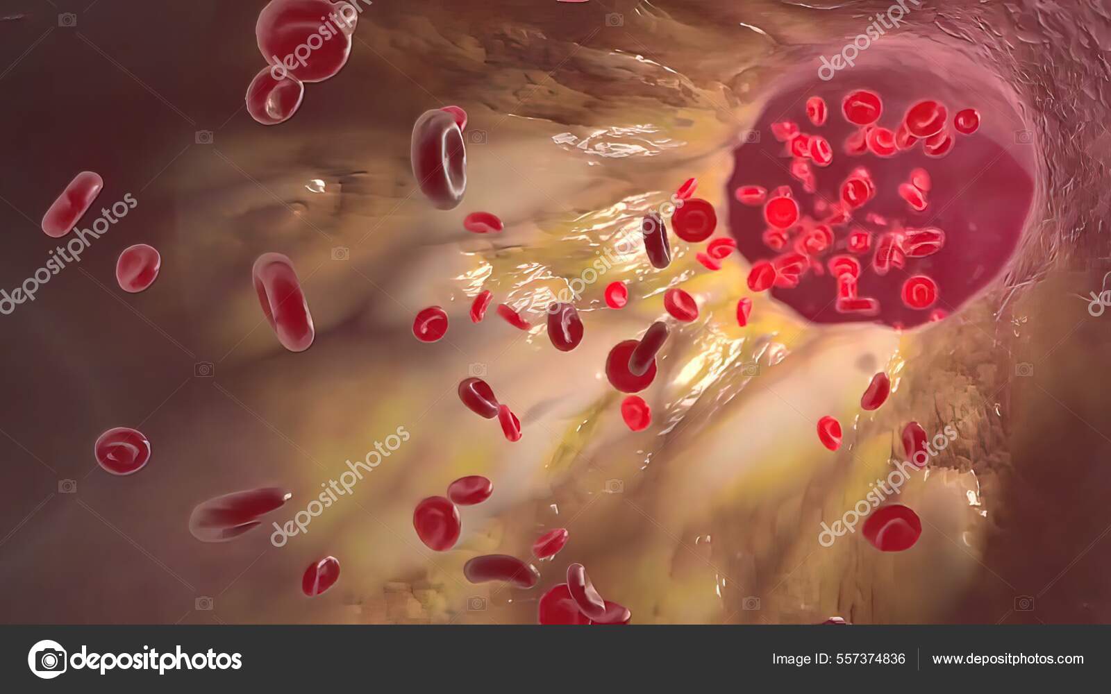 Atherosclerosis Hardening Narrowing Your Arteries Caused Cholesterol