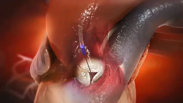 Sostituzione Della Valvola Aortica Transcatheter Una Procedura Minimamente Invasiva Sostituire — Foto Stock