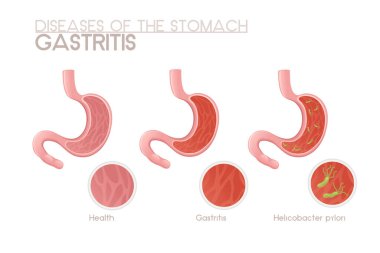 Helicobacter pillori ve gastrit karikatür tasarımlı insan midesi beyaz arka planda insan anatomisi organ çizimi