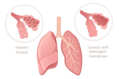 Zarar görmüş zar çizgi film tasarımlı insan ciğerleri alveolü beyaz arka planda insan anatomisi organ çizimi