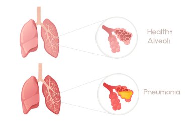 Pnömoni çizgi film tasarımlı insan ciğerleri alveolü beyaz arka planda insan anatomisi organ vektör çizimi