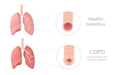 Bronşit karikatür dizaynlı insan akciğerleri beyaz arka planda insan anatomisi organ çizimi