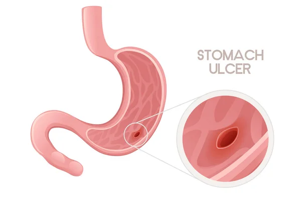 Umano Ulcera Stomaco Disegno Del Fumetto Anatomia Umana Organo Vettoriale — Vettoriale Stock