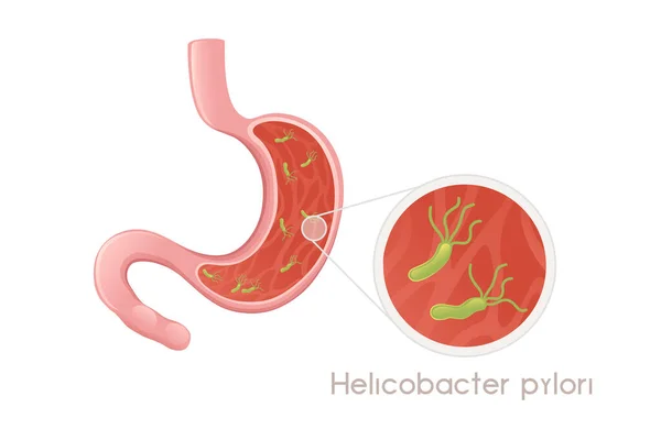 Stomaco Umano Con Helicobacter Pylori Disegno Del Fumetto Anatomia Umana — Vettoriale Stock