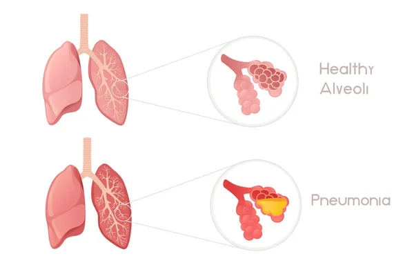 Alvéolos Pulmões Humanos Com Pneumonia Desenho Animado Anatomia Humana Vetor —  Vetores de Stock