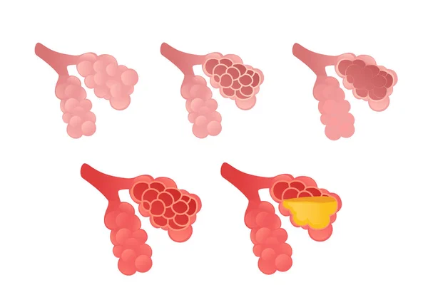 Set Disegno Del Fumetto Alveoli Umano Anatomia Umana Organo Vettoriale — Vettoriale Stock