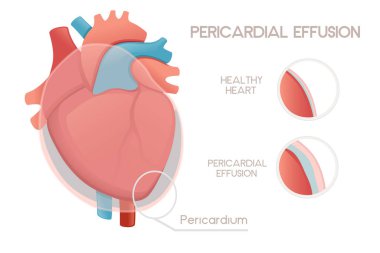 Unhealthy human heart with pericarditis disease anatomy illustration health problem vector illustration on white background. clipart