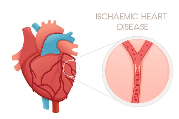 Coração Humano Insalubre Com Doença Isquêmica Anatomia Ilustração Problema Saúde —  Vetores de Stock