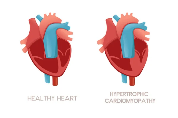 Hipertrofik Kardiyomiyopati Hastalığı Olan Sağlıklı Insan Kalbi Kalbi Beyaz Arka — Stok Vektör