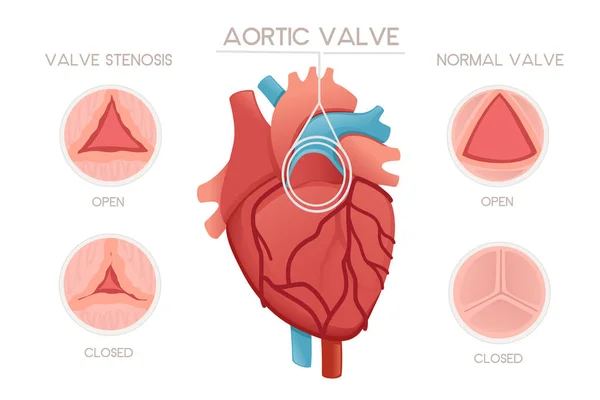 Coração Humano Saudável Com Válvulas Estenose Valvar Doença Anatomia Ilustração —  Vetores de Stock