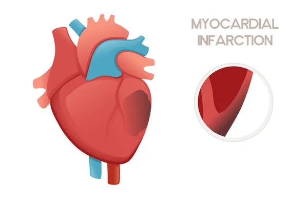 Coração Humano Insalubre Com Infarto Miocárdio Anatomia Doença Ilustração Problema —  Vetores de Stock