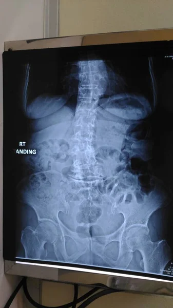 X光机上的X光片显示了退化的骨骼 — 图库照片