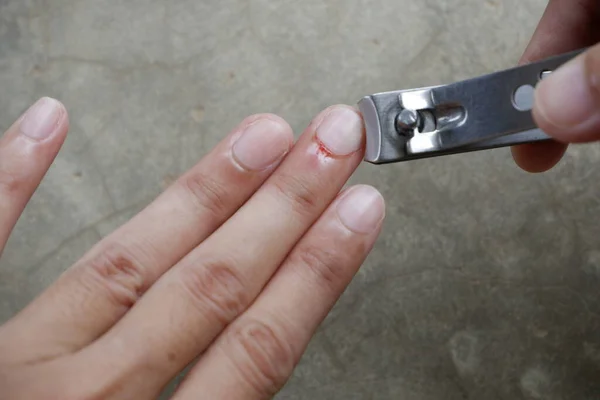 Вырезать Длинные Раненые Ногти — стоковое фото