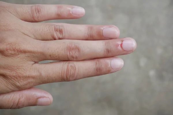 Bleeding Wound Pulling Skin Base Middle Finger — Stock Photo, Image