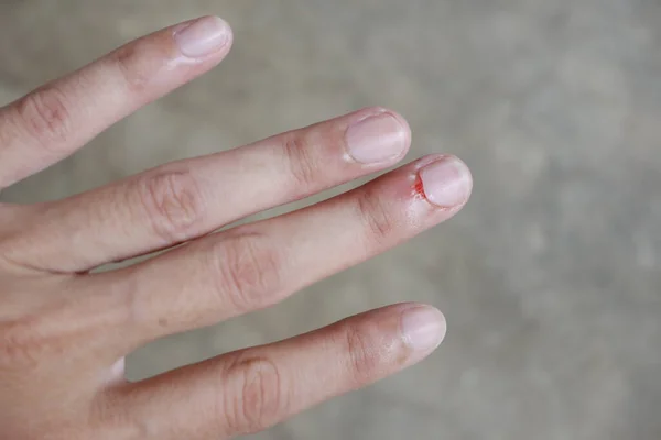 Wound Bleeding Base Nail — Stock Photo, Image