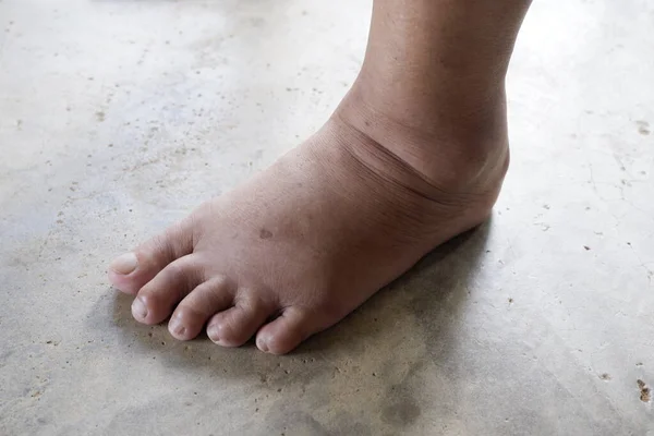 Swollen feet in the elderly