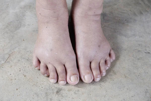 Swollen feet in the elderly on floor