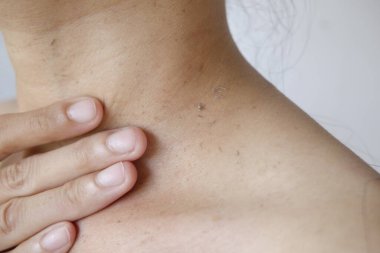 Cesetten kir çıkarmak için boynundaki ölü deriyi kaplayın.