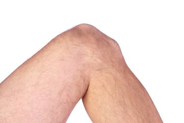 Osgood Schlatter Hastalığı Beyaz Arkaplan 'da izole edilmiş bir Mans dizine yakın çekim