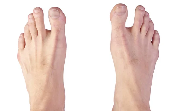 Nahaufnahme eines Mans-Fußes, der eine Fehlbildung der Sandalenspalte aufweist, auch als Hallux Varus bekannt — Stockfoto