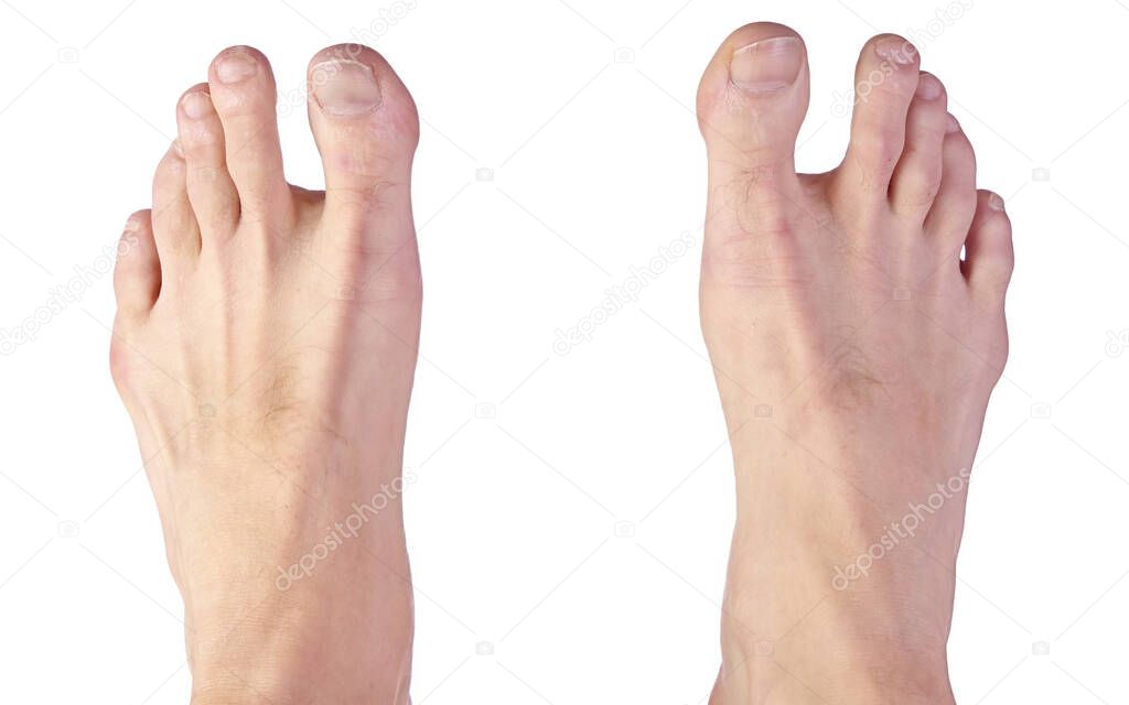 Close up of a Mans Feet Showing Sandal Gap Deformity, also known as Hallux Varus
