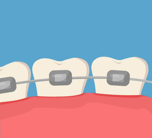 Concept Alignement Des Dents Avec Les Accolades Des Dents Simples — Image vectorielle