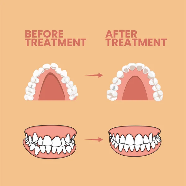 Teeth Treatment Vector Icon Illustration Teeth Braces Vector Flat Cartoon —  Vetores de Stock