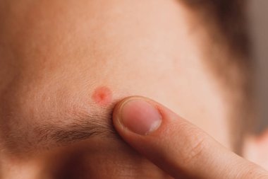 Adamın alnındaki sivilce kaşının üstünde. Renk yakın planına göre belirlendi