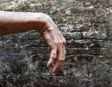 Radyal sinir hasarı ya da Asyalı ihtiyarın bilek damlası..