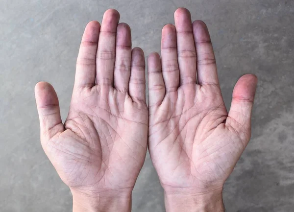 Cyanotyczne Dłonie Lub Sinica Obwodowa Lub Niebieskie Dłonie Azji Południowo — Zdjęcie stockowe