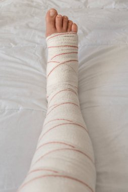 Bendage 'da kırık bir bacak.