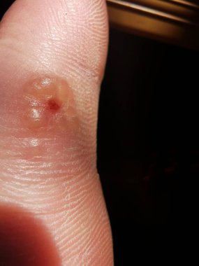 Garip ayak mantarı. Kuru cilt.