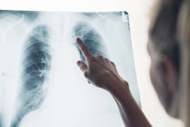 Unrecognisable blonde female doctor pointing at x-ray of patients lungs. Close up. Studio shot. Isolated copy space. High quality photo