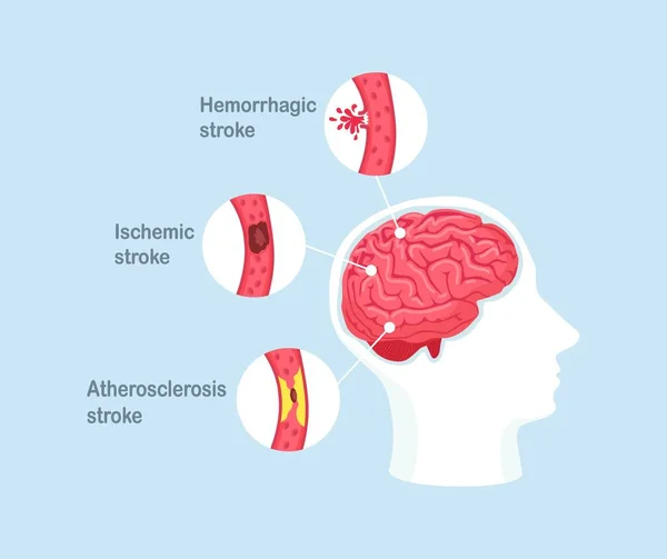 Tipos Derrame Cerebral Humano Doença Isquémica Aterosclerose Acidente Vascular Cerebral —  Vetores de Stock