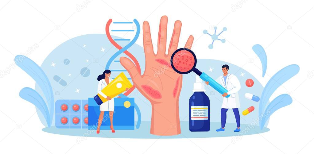 Dermatologist Exam Big Hand with Red Skin and Ras. Psoriasis, Vitiligo, Dermatitis. Eczema - Inflammation Skin Disease. Consequences of Improper Care, Frequent Hand Washing, Disinfection