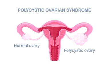 Polycystic ovary syndrome. PCOS hormonal diagnose. Female reproductive system with ovary, uterus, fallopian tubes. Female organs disease clipart