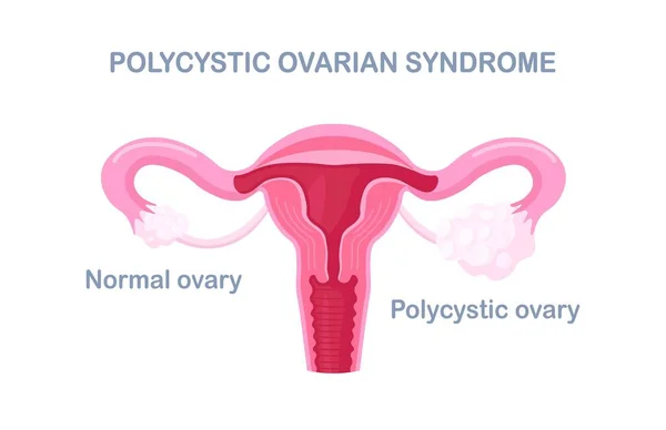 Синдром Поликистозных Яичников Гормональный Диагноз Пкс Женская Репродуктивная Система Яичником — стоковый вектор