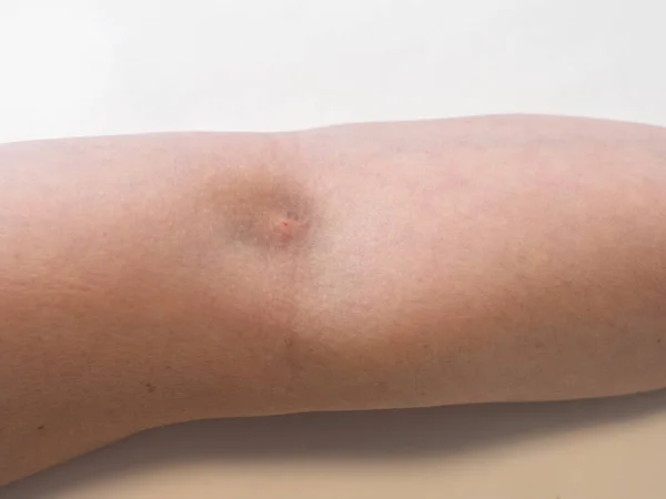 Hand Trace Injection Syringe Bruise White Background Man Hand Bruise — Stock Photo, Image