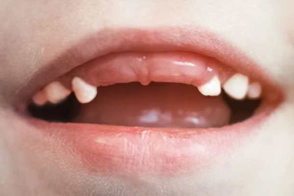 Photo of a childs mouth missing his two front teeth. Close-up — Stock Photo, Image