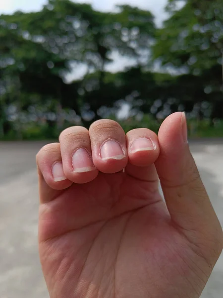 Clavo Roto Dedo Cuidado Uñas Salud —  Fotos de Stock