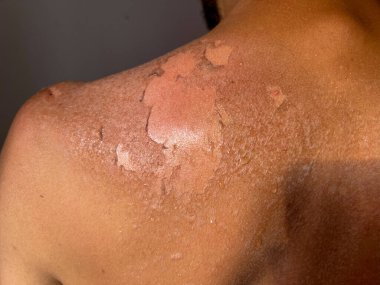 Peel back and shoulder skin from sunburn effect on young man body from sunbathing in summer