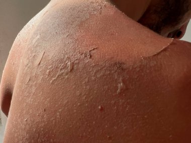 Peel back and shoulder skin from sunburn effect on young man body from sunbathing in summer