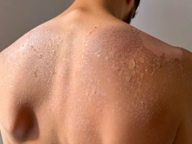 Peel back and shoulder skin from sunburn effect on young man body from sunbathing in summer